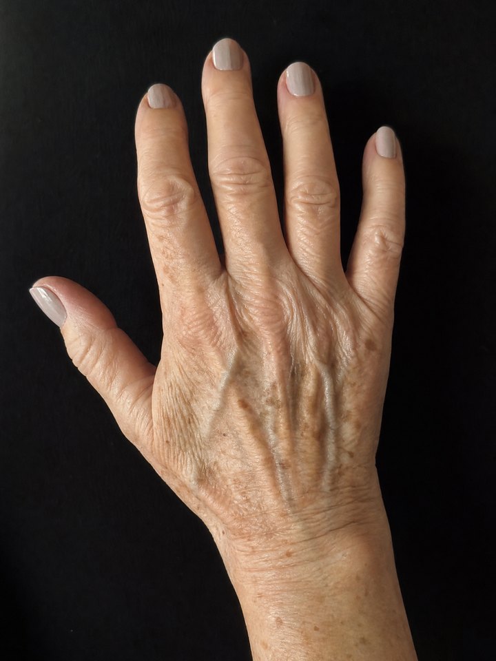 Aged hand before using YouthLift