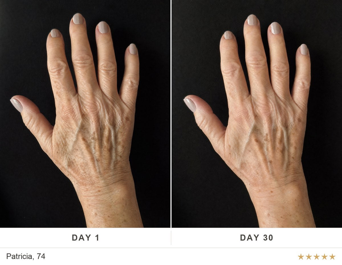 Before and after, Patricia, 74