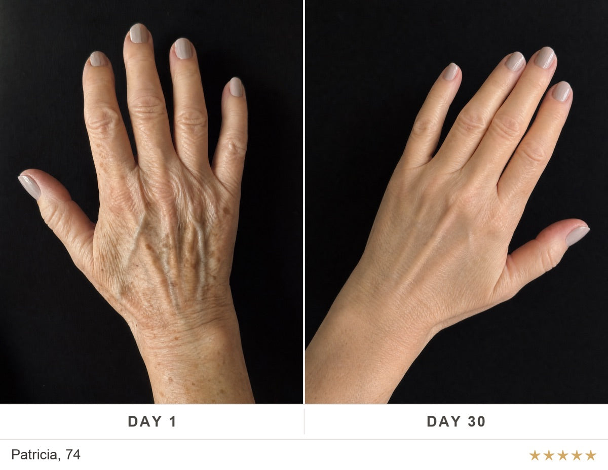 Before and after, Patricia, 74
