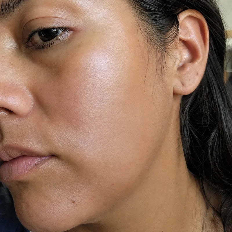 Cheeks after Plumessa