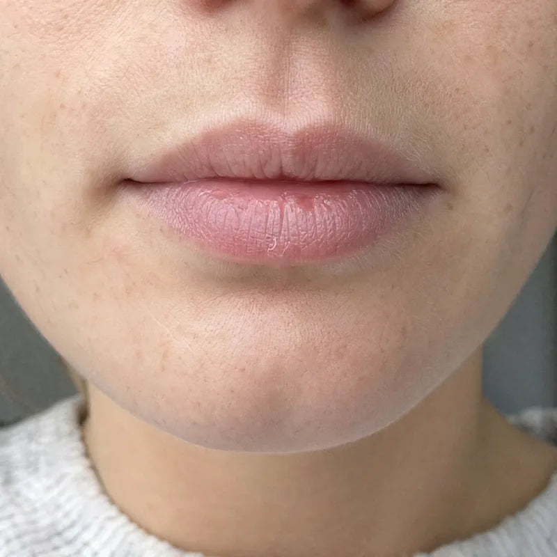 Lips before Plumessa