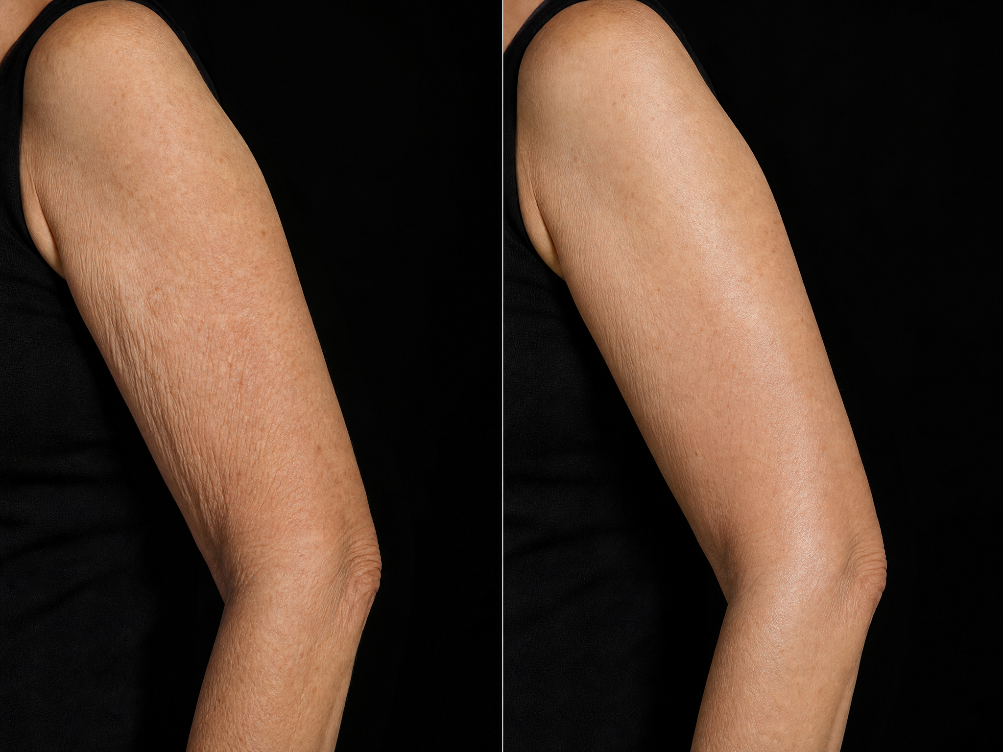 Upper arm before and after using YouthLift