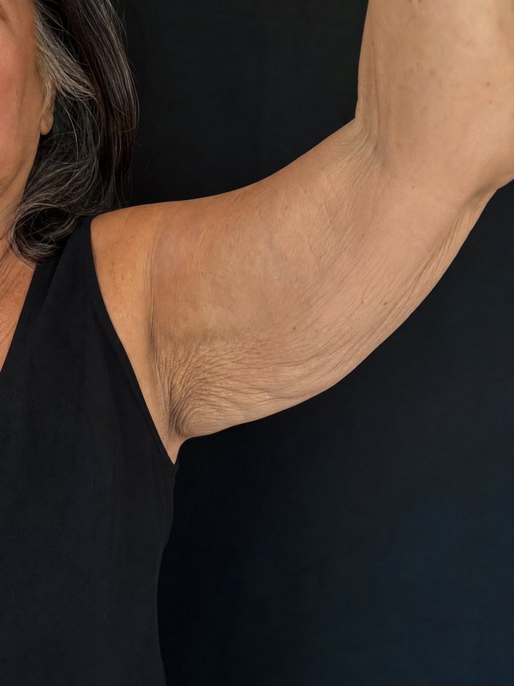 Crepey upper arm before using YouthLift