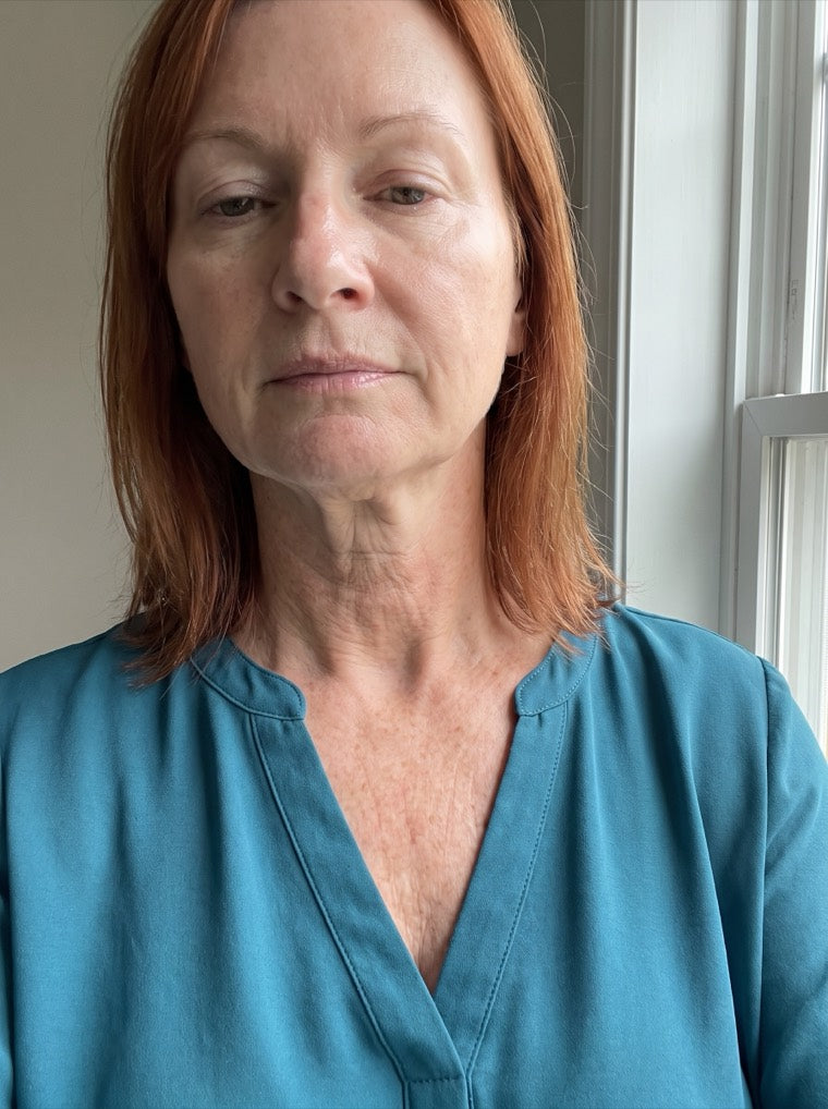 Karen's firmer, smoother neck after using YouthLift