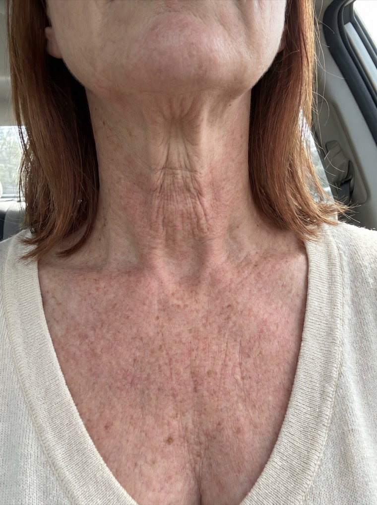 Karen's deeply lined neck before using YouthLift