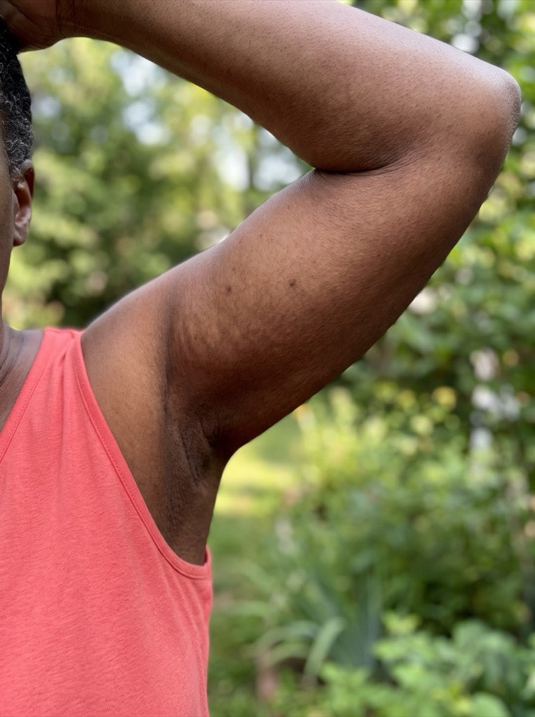 Denise's firmer upper arm after using YouthLift