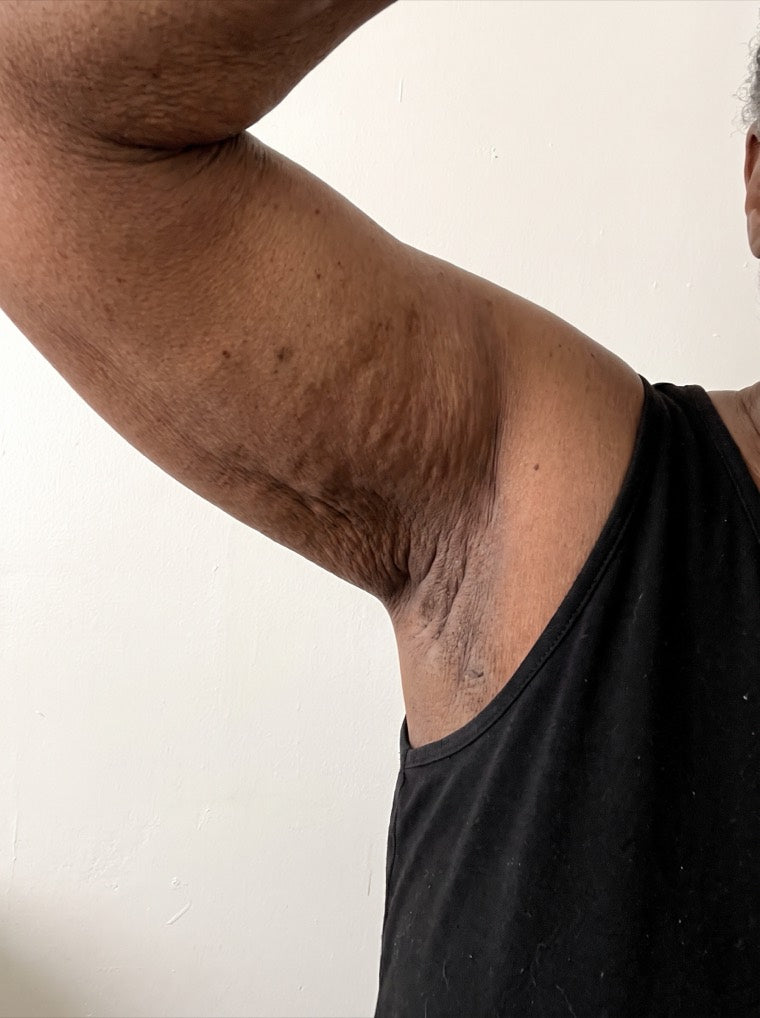 Denise's crepey upper arm before using YouthLift