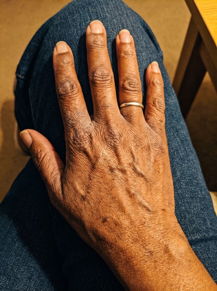 Gloria's dry, aged hand before using YouthLift