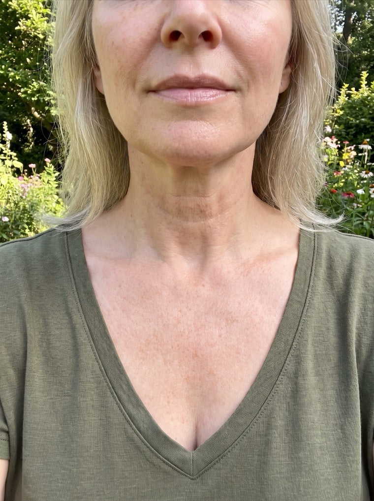 Susan's firmer, smoother neck after using YouthLift