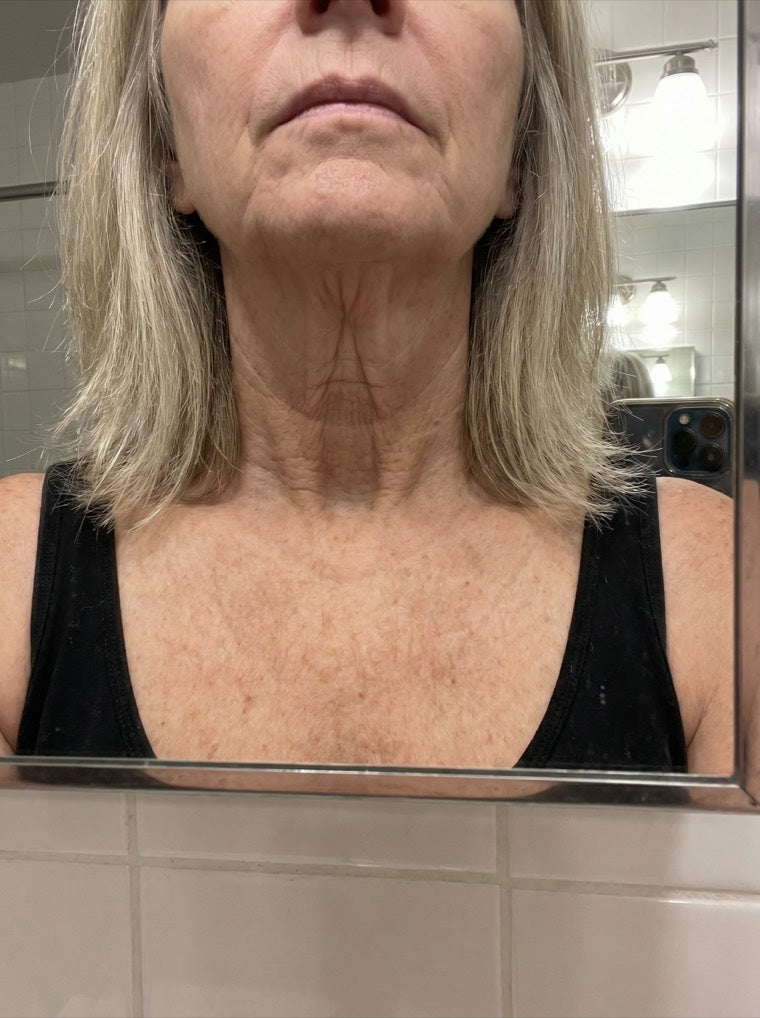 Susan's crepey neck before using YouthLift