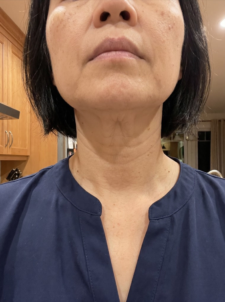 Mei's firmer, brighter neck after using YouthLift