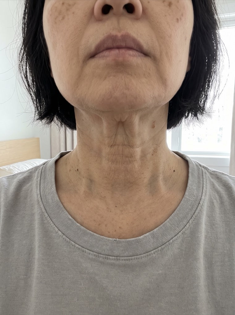 Mei's lined neck before using YouthLift