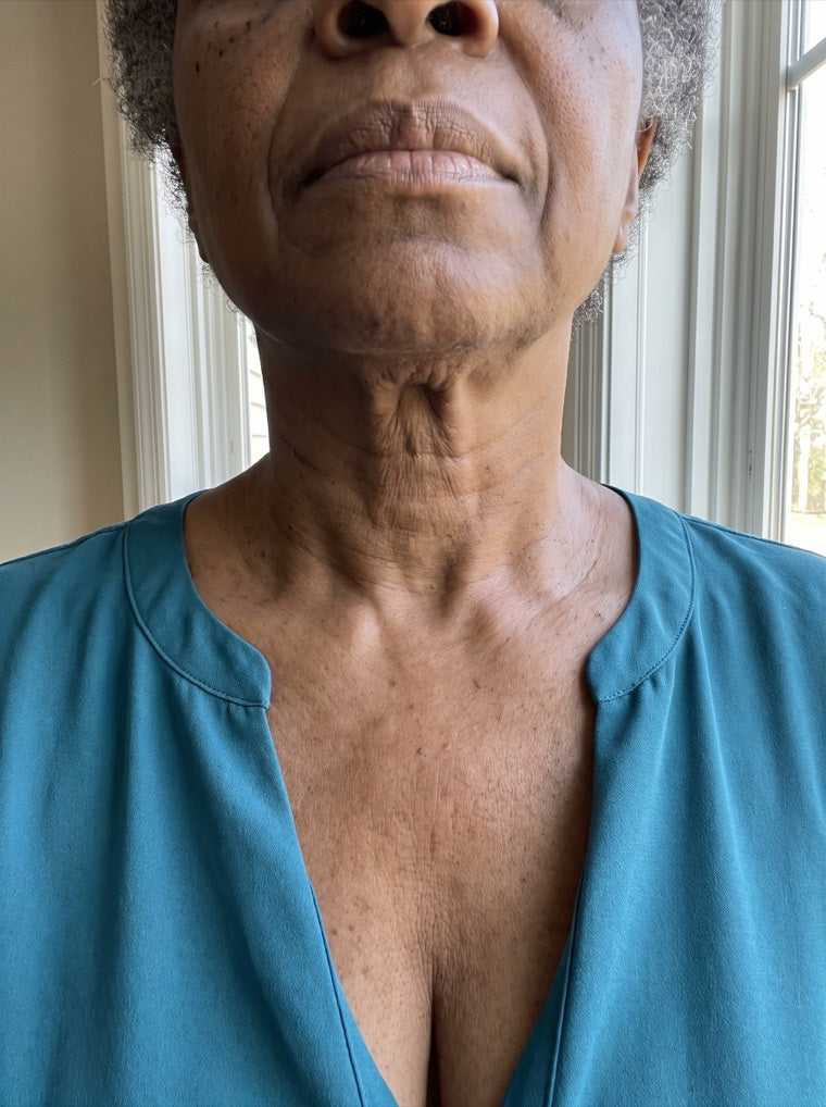 Yvonne's even, smoother d&eacute;colletage after using YouthLift