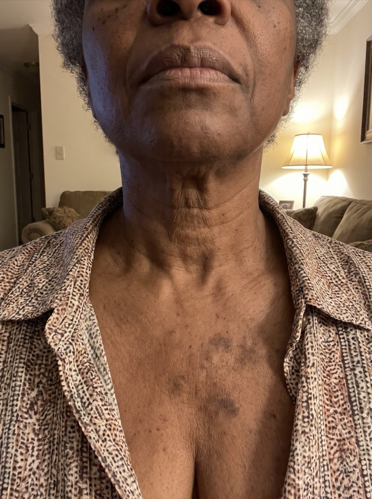 Yvonne's uneven d&eacute;colletage before using YouthLift
