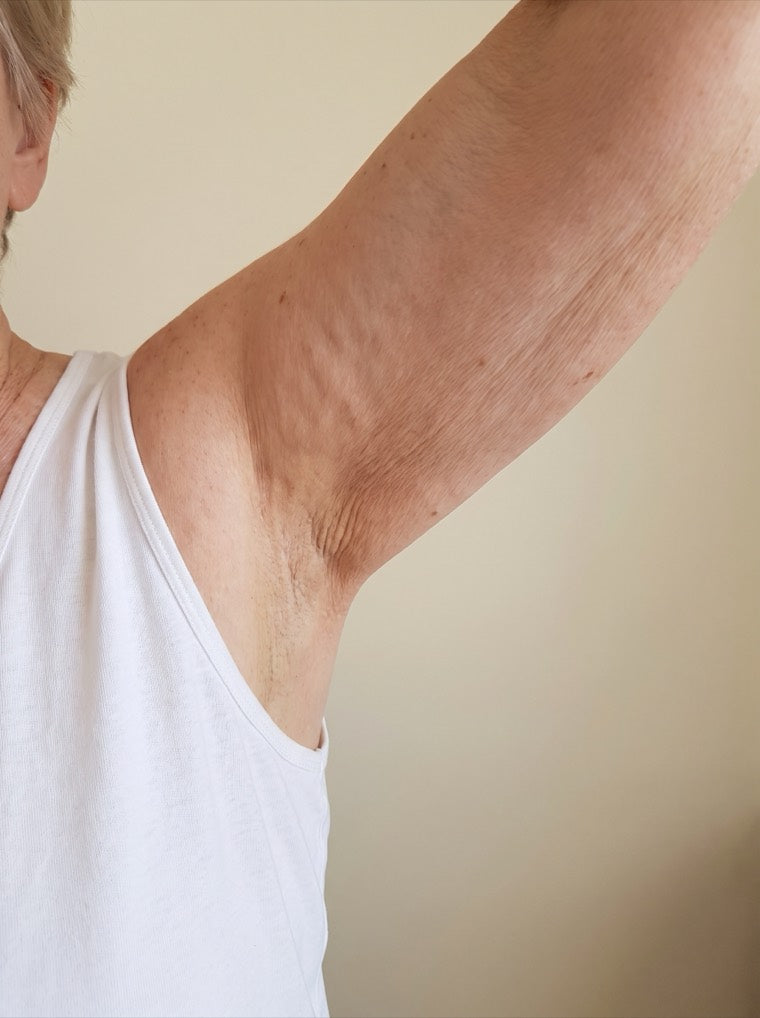 Janet's crepey upper arm before using YouthLift