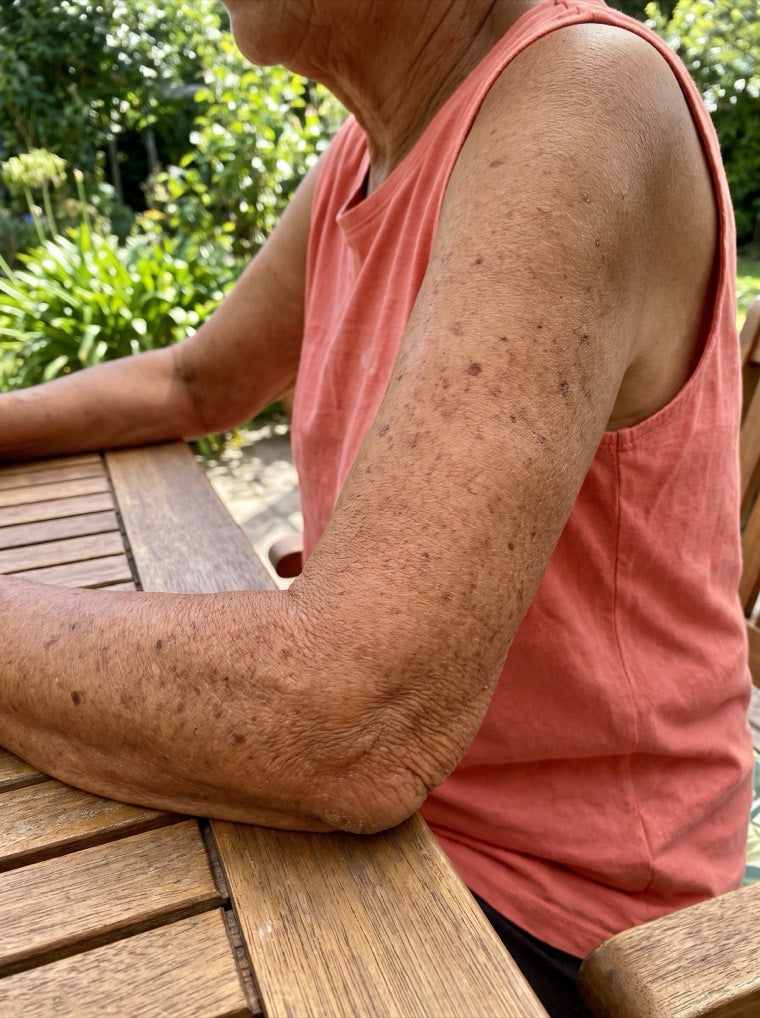 Diane's sun-damaged forearm before using YouthLift