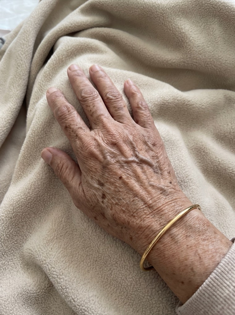 Anita's heavily spotted hand before using YouthLift